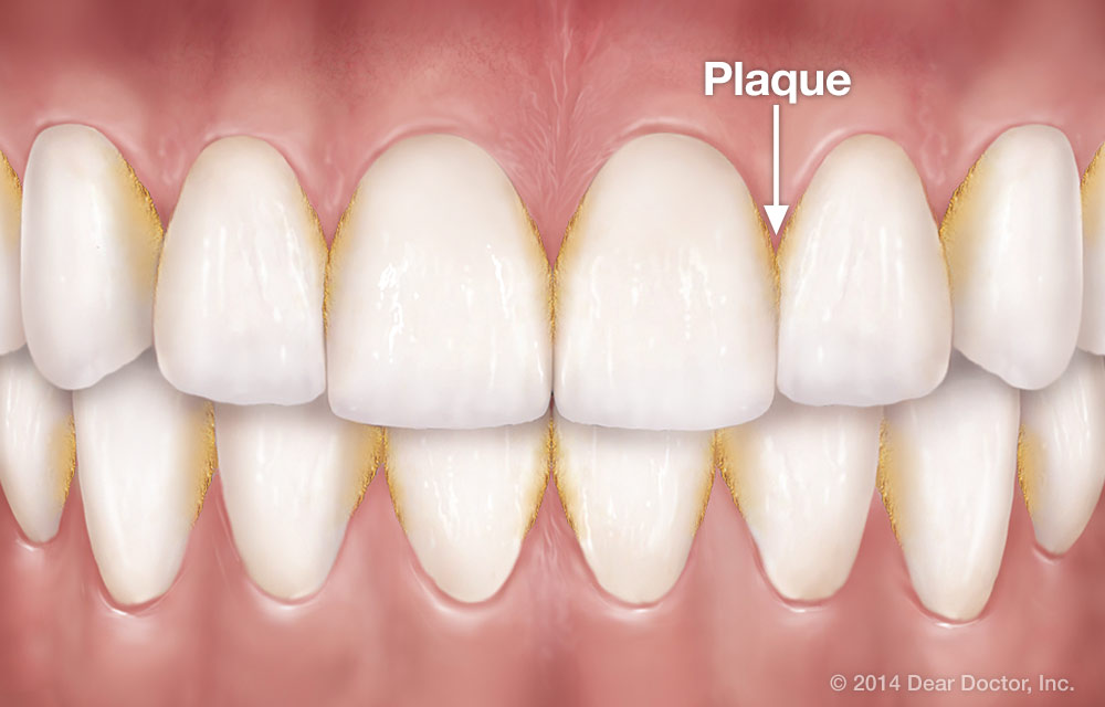 Tartar and plaque removal for a healthy pearly whites