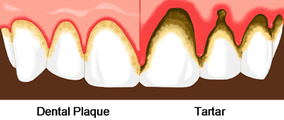 Dental Tartar