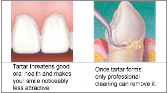 dissolve tartar from teeth
