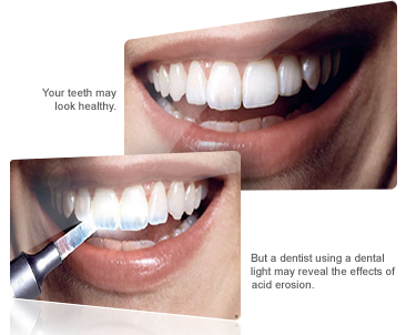 teeth loss of enamel