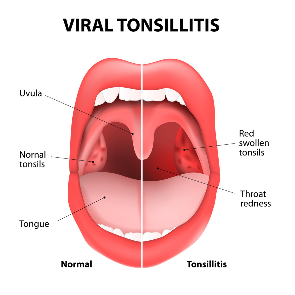 viral tonsillitis or upper respiratory tract infection. URI or URTI.