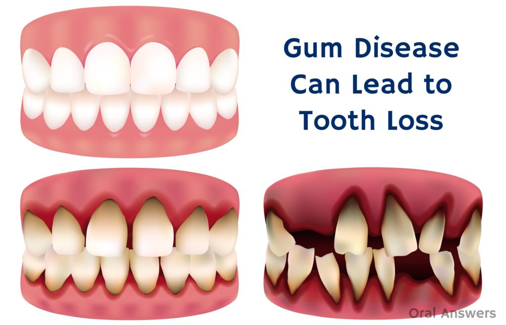 gum-disease-which-have-the-scientific-name-as-gingivitis