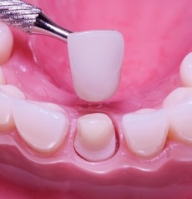 Dental Restoration