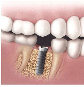 Implantology Treatment