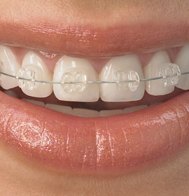 Invisible Orthodontics