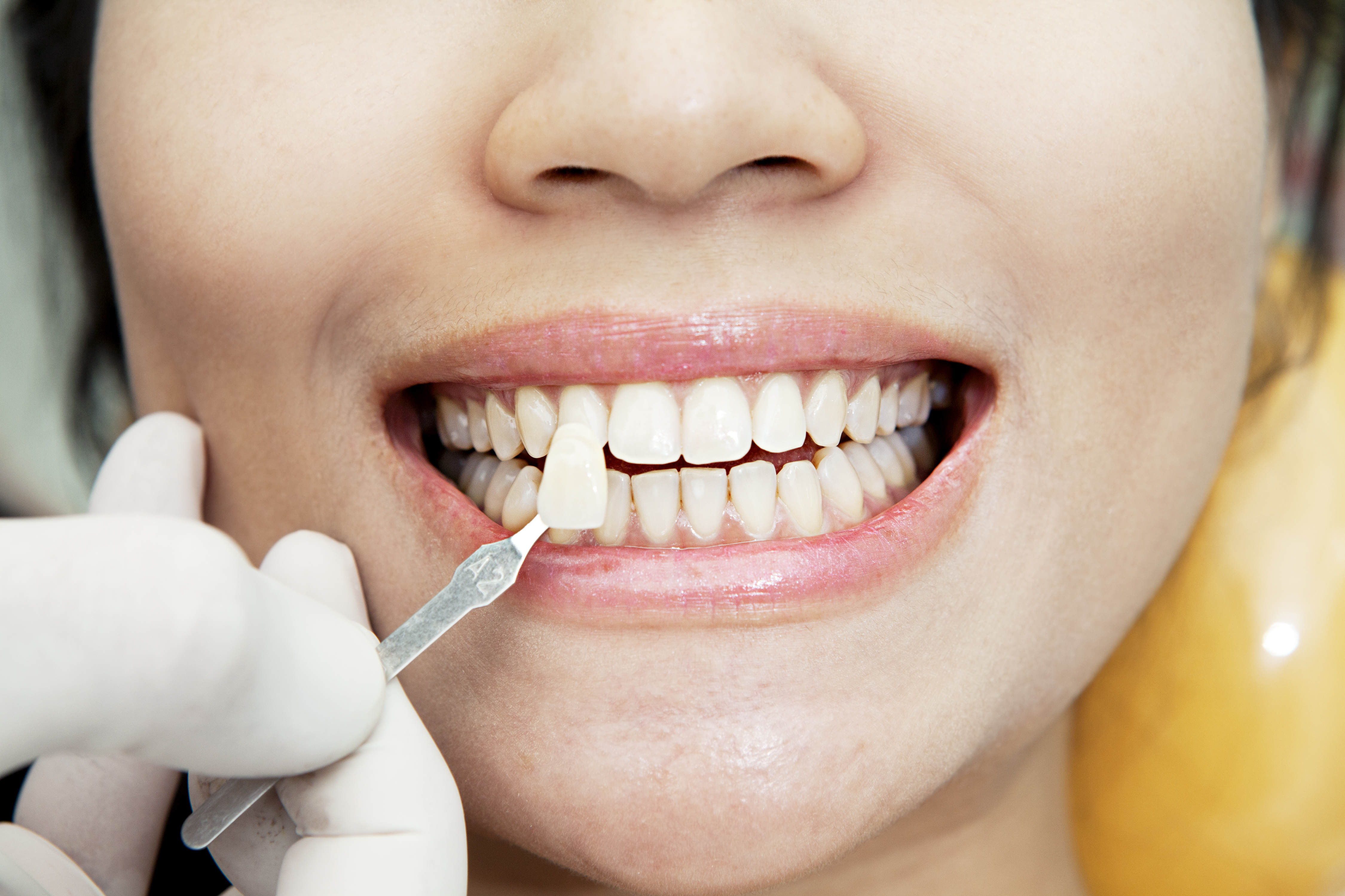 Whitelight Teeth Whitening System - The Best Teeth Whitening Product?