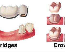 Diet, diabetes and tooth decay in a glimpse