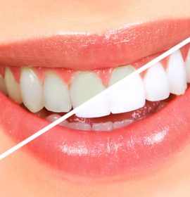 Whitening and Dental Care
