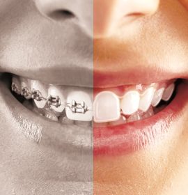 Dr.Nechupadam Dental’s Clear Aligners